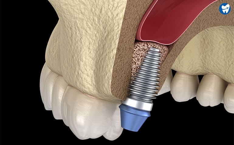 Sinus lift