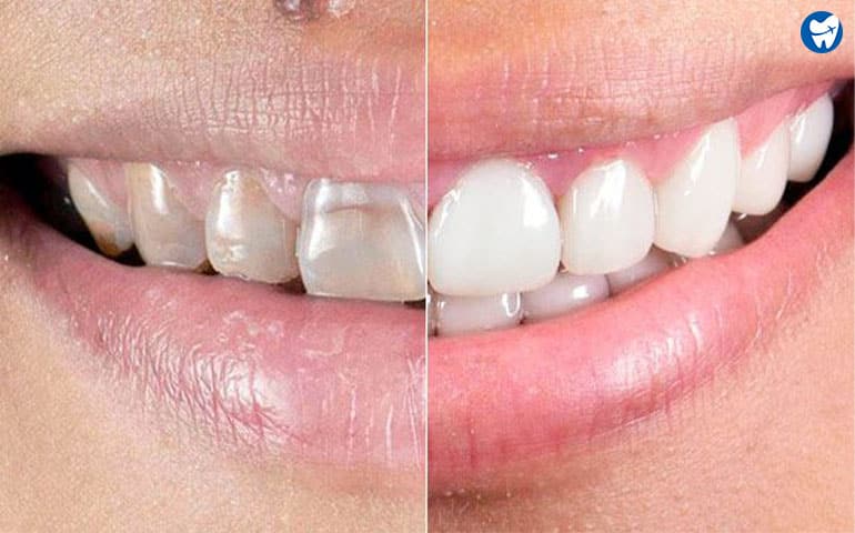 Smile Makeover in Mexico