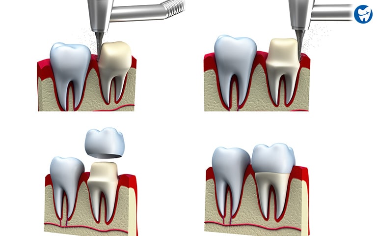 Dental crown preparation