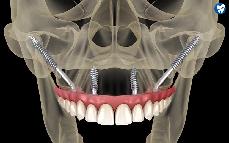 Zygomatic implants