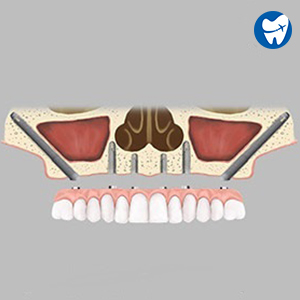 Zygomatic Dental Implants