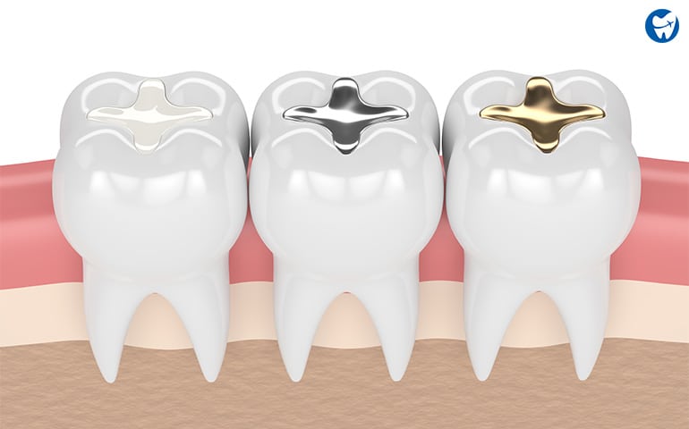 Dental Fillings