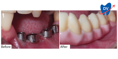 Dental Implants in Costa Rica Before and After