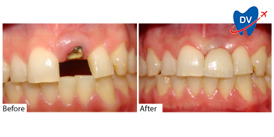 Dental Implants in Costa Rica Before and After