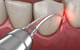 Dental Laser