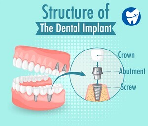 Structure of dental implant