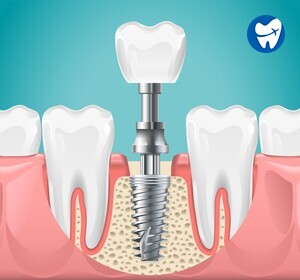 Teeth implants