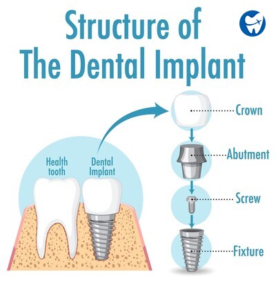 Dental Implant