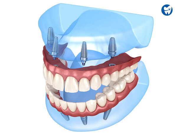 All on 4 dental implants