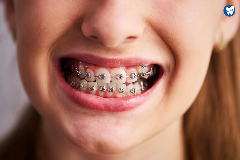 Metal Braces