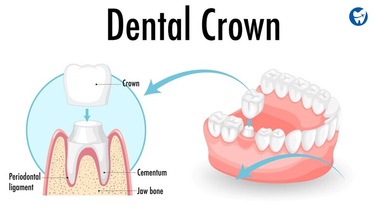 Dental Crown