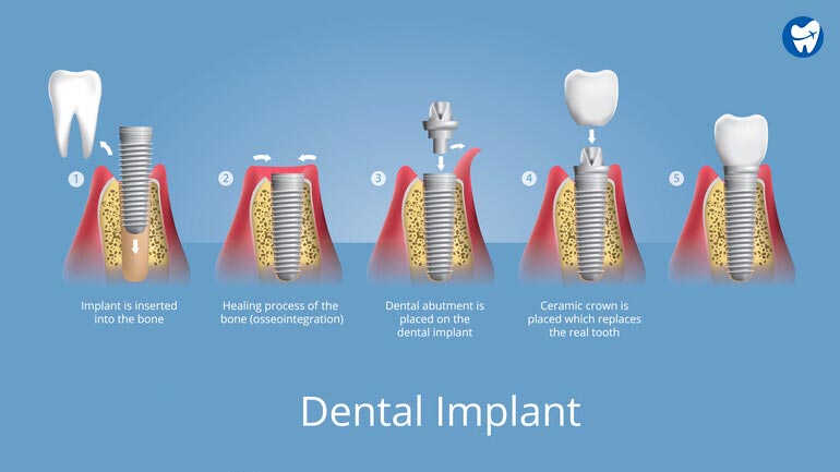 Dental Implant Technique