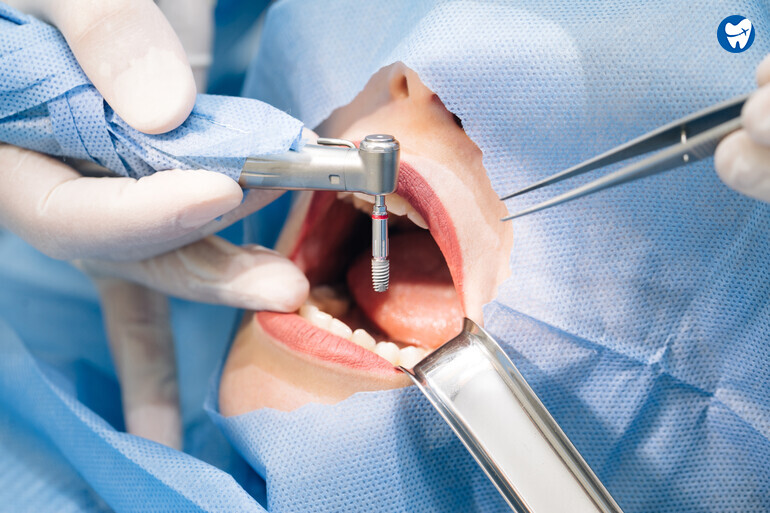 Dental Implant