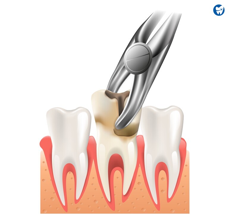 Tooth extraction