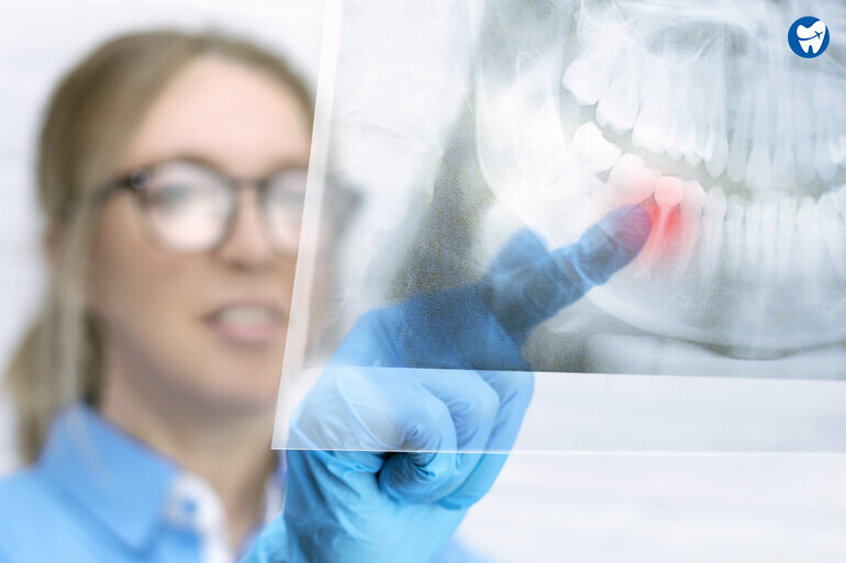 Full Mouth X-ray taken before extraction