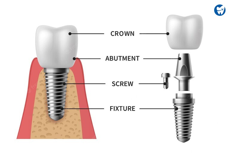 Dental implant structure