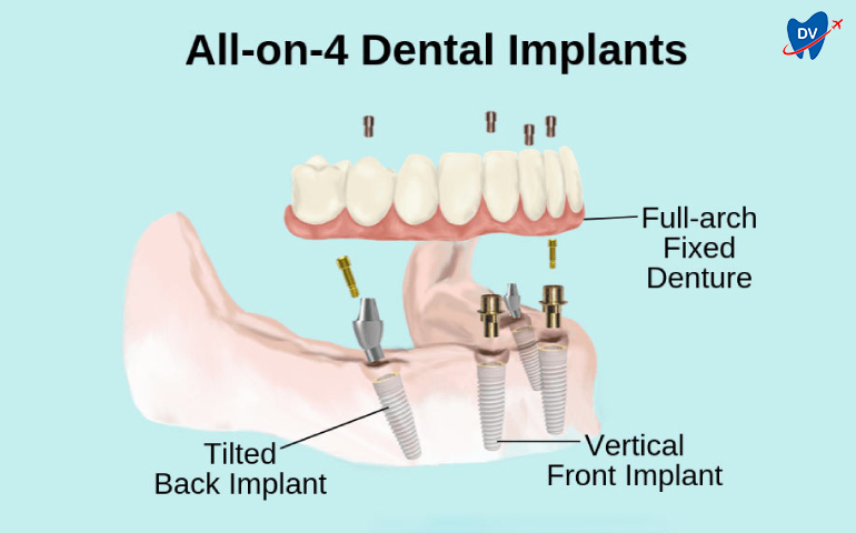 All on 4 Dental Implant in Costa Rica