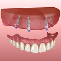 All-on-4 Dental Implants