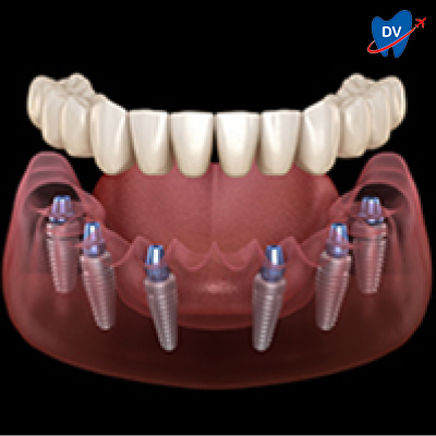 All on 6 Dental Implants Tijuana