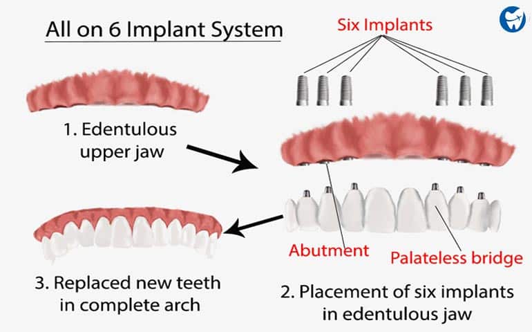 All on 6 Dental Implant System