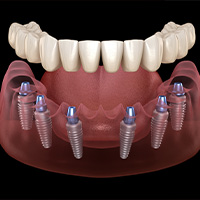 All on 6 Dental Implant