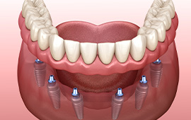 All-on-6 Dental Implants