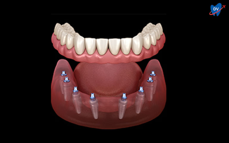 Dental Implants