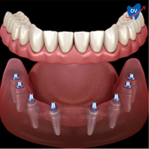 All on 8 Dental Implants 