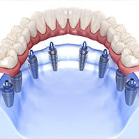 All on 8 dental implants