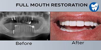 Full Mouth Reconstruction Before and After