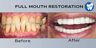 Full Mouth Reconstruction Before and After