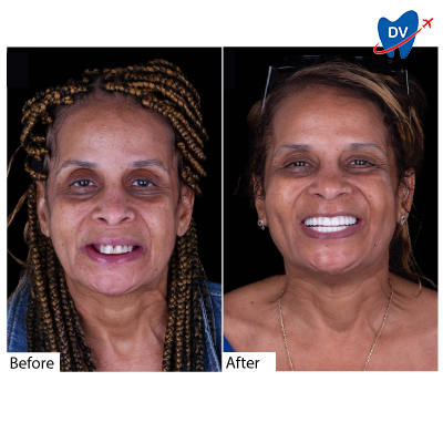 Before & After Dental Bridge in Mexico