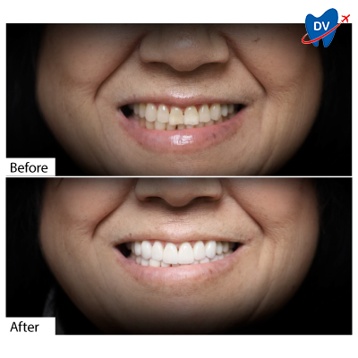 Before & After Dental Veneers | Los Algodones, Mexico