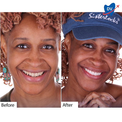 Before & After Dental Veneers | Los Algodones, Mexico