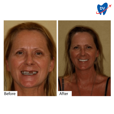 Dental Implants in Cancun, Mexico: Before & After 