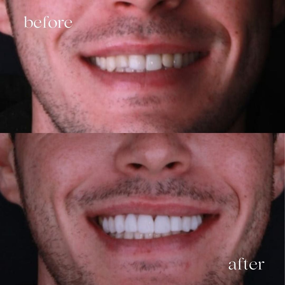 A patient getting dental veneer at quality international dental clinic, tijuana; a DentaVacation partner clinic.