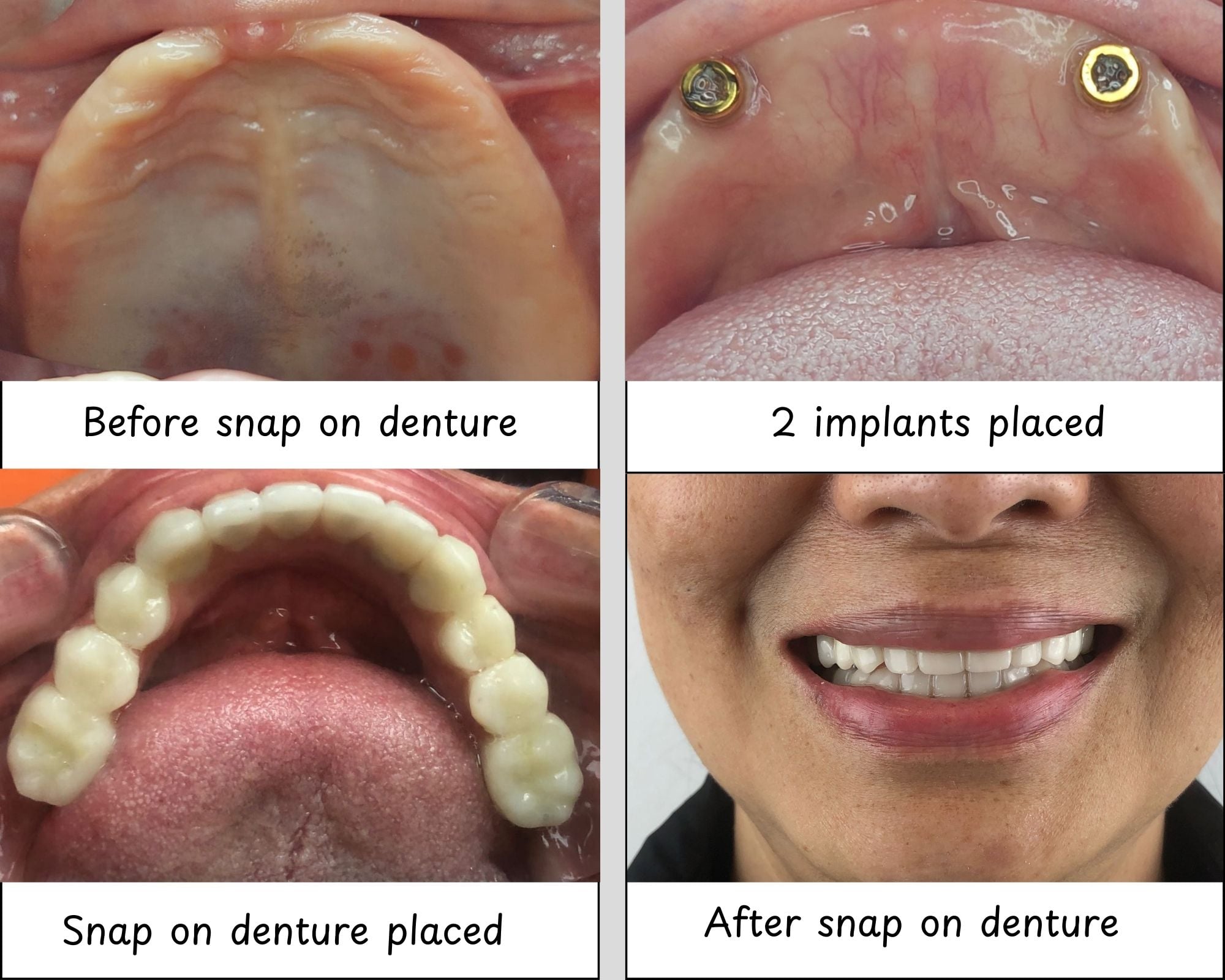 snap on dentures with two implants at dental 3 smiles, tijuana. This is one of the most sought after dental work in Tijuana.