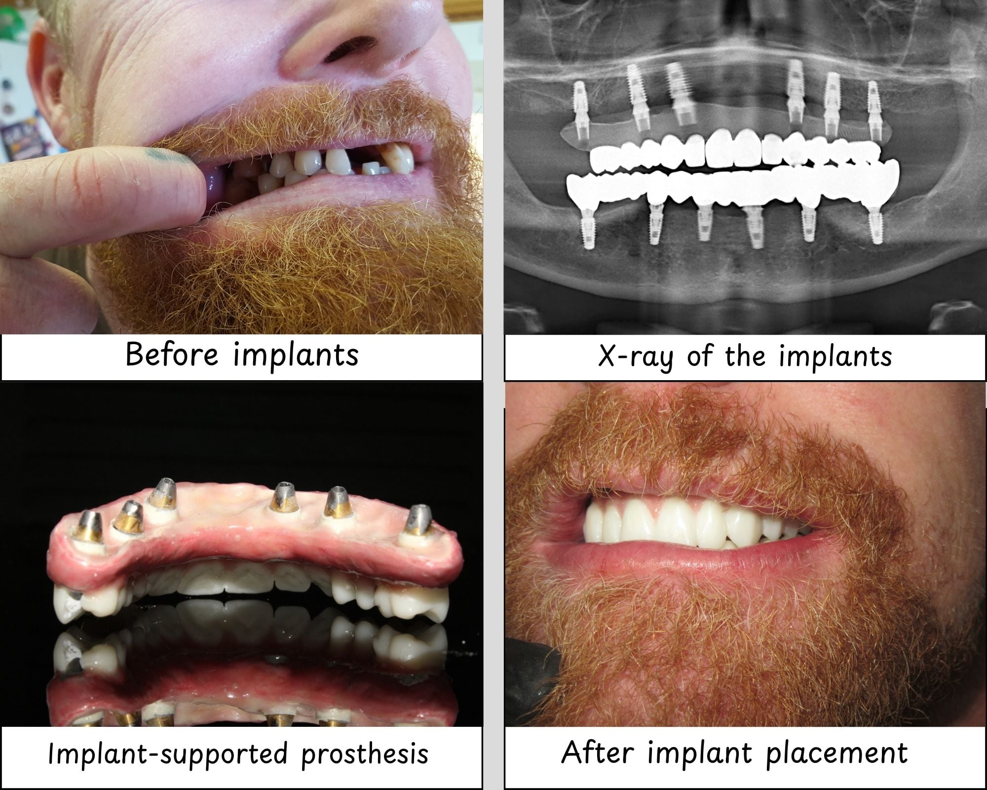 Process of getting dental implants at Dental Brush, a partner clinic of DentaVacation in Tijuana, Mexico.