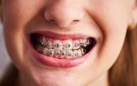 Braces in HCMC, Vietnam