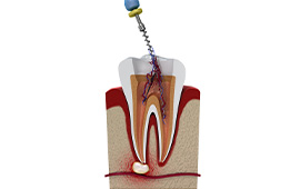Root Canal Treatment