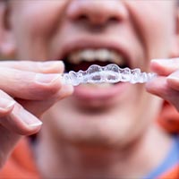 Clear aligners in Guatemala