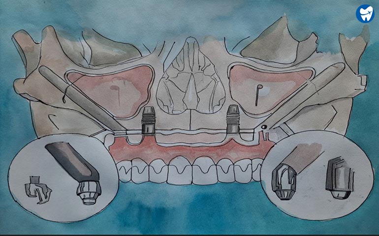 Components of Zygomatic Implants