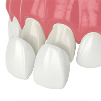 Composite Veneers