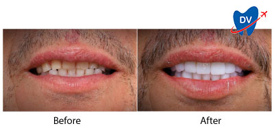 Cosmetic dental work in Algodones Before & After