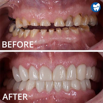 Dental crowns in Mexico- before and after