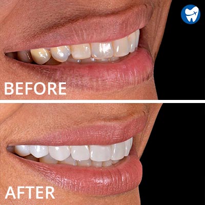 Dental veneers in Mexico - before and after