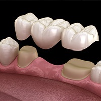 Dental Bridge