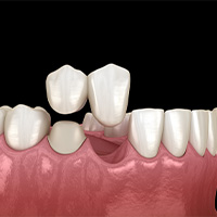 Dental Bridges