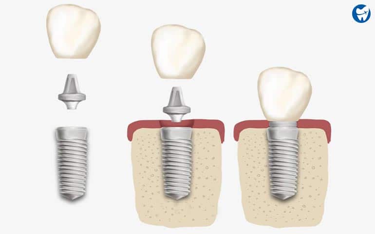 Single tooth implant