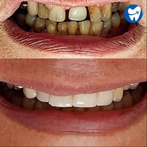 Dental Implants: Before & After